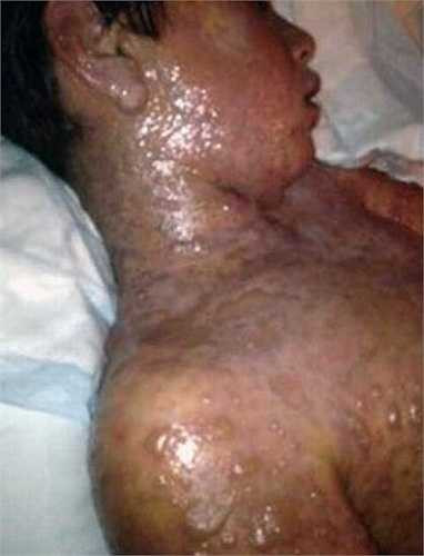 Năm 11 tuổi, Calvin Lock có dấu hiệu bị viêm, mẹ của cậu bé đã vội vàng cho cậu bé uống thuốc ibuprofen (một loại thuốc kháng viêm).