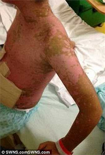 Tuy nhiên sau 3 tuần nằm điều trị, các vết phồng rộp trên người Lock ngày càng bị lở loét và nhiễm trùng. 