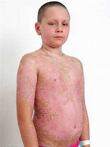 Cuối cùng họ đã quyết định chuyển cậu bé tới khoa bỏng để các bác sỹ phẫu thuật tại đây tiến hành loại bỏ hết chỗ da bị phồng rộp trên cơ thể Lock. Họ cho biết tình trạng dị ứng của cậu bé rất nghiêm trọng nên có thể cậu sẽ không thể qua khỏi.