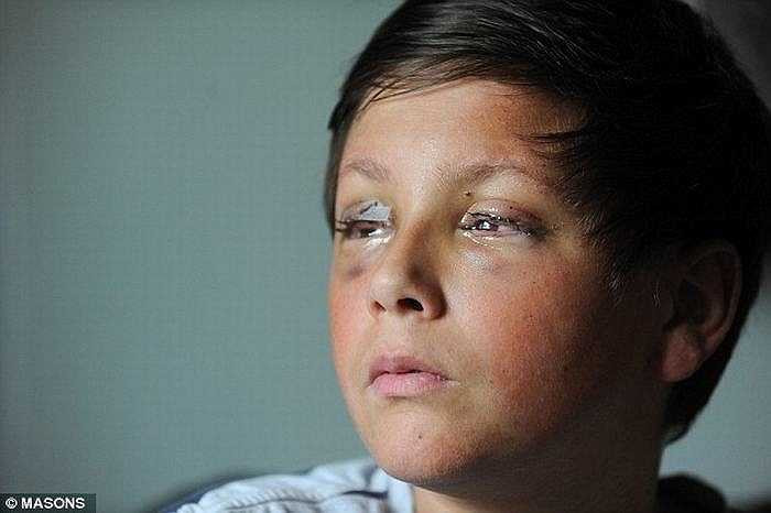 Sau 2 năm điều trị, da của Lock đã dần bình phục tuy nhiên gần đây mắt của cậu bé có nguy cơ bị mù do phản ứng phụ sau dị ứng thuốc. 