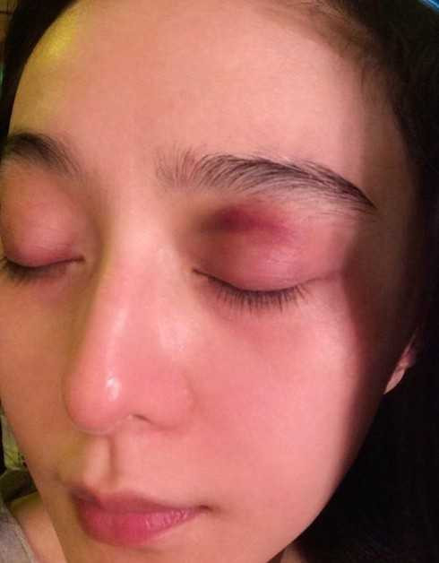 băng phạm bị thương 2