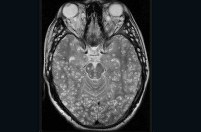Cận cảnh loài giun sán làm tổ trong não người 