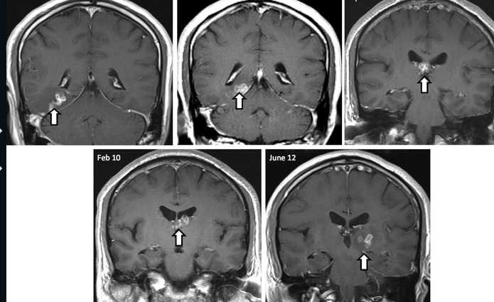 Loài giun này di chuyển trong não người đàn ông trong theo các mốc thời gian 