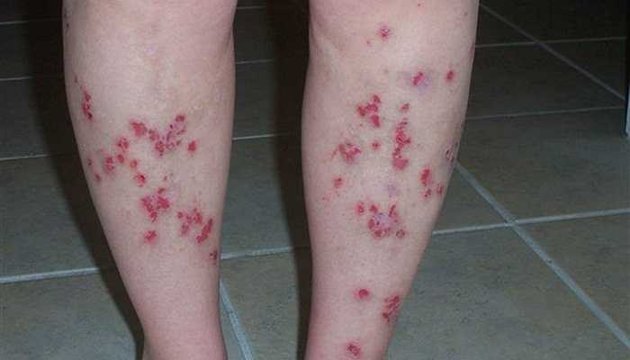 Chứng Morgellons - Những người mắc căn bệnh này thường mô tả cảm giác có côn trùng hay động vật ký sinh bò ở dưới da, còn tại những vết thương không kín miệng, có những sợi màu xanh dương và trắng, đôi khi to bằng sợi mỳ spaghetti thòi ra. 