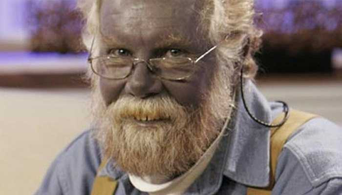 Argyria - Một loại bệnh do sự gia tăng của hợp chất bạc trong da và khi gặp ánh nắng mặt trời, hợp chất này chuyển thành màu xanh.