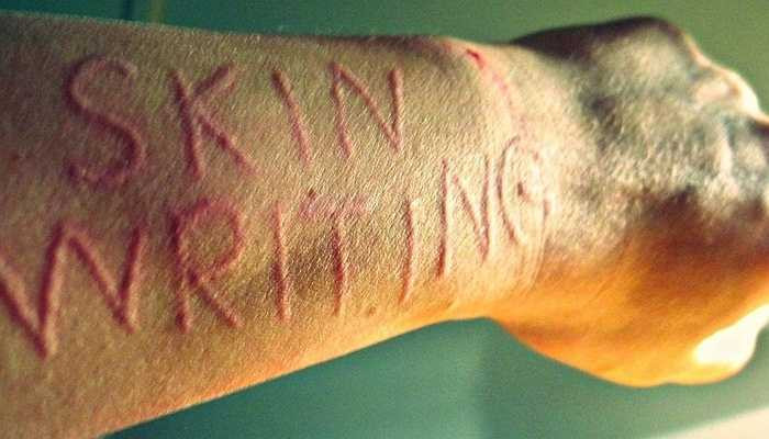 Bệnh Da vẽ nổi - hay còn gọi là rối loạn chức năng của da. Da của người bệnh sẽ bị hằn lên, thậm chí sưng lên hoặc nổi mề đay khi bị tác động, vuốt ve, cọ xát, gãi. Nguyên nhân là do bề mặt da tự sản xuất histamine