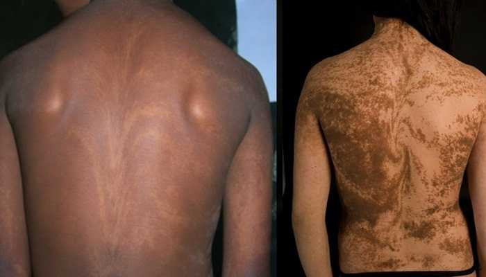 Bệnh viêm da Blaschko - Đây là loại bệnh cực hiếm do đột biến gen khiến các sắc tố trên da thay đổi tạo ra những đường cong trên da. 