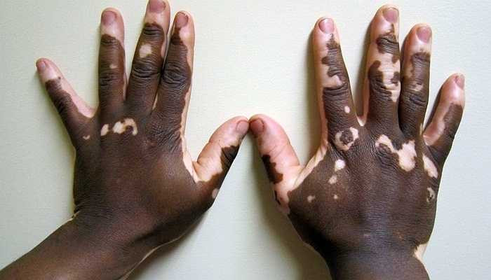Vitiligo - Là bệnh gây nên từ việc mất sắc tố của da và nó thường ảnh hưởng tới các chi trên cơ thể. Các tế bào sắc tố này bị chết đi và khiến cho da người bị mất đi màu sắc đặc trưng. Tuy nhiên, bệnh này không gây ảnh hưởng nhiều đến sức khỏe 