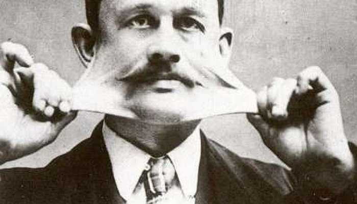 Hội chứng Ehlers-Danlos - là bệnh di truyền. Biểu hiện điển hình của bệnh là da, mô, khớp lỏng lẻo do việc sản xuất các collagen bất thường. Bệnh gặp ở mọi chủng tộc trên thế giới, cả ở nam và nữ.