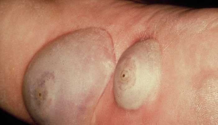 Tungiasis là bệnh mà da bị tàn phá bởi 1 loại bọ chét tên là Tunga. Những con bọ chét này đào hang trên da người và đẻ trứng trên đó, gây ra bệnh mà thực tế xuất hiện rất phổ biến ở Nigeria, Trinidad và Tobago - những nơi mà tỉ lệ mắc bệnh tungiasis ở trẻ em rất cao (40%) vào thập niên 80 của thế kỉ trước.