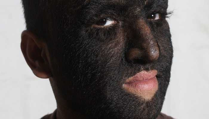 Hypertrichosis bẩm sinh là một thuật ngữ y tế chỉ tình trạng tóc phát triển quá mức, lan cả ra cả mặt. Hội chứng này còn có tên gọi khác là bệnh người sói. Bởi lẽ, khi tóc phát triển khắp trên mặt, bệnh nhân sẽ có khuôn mặt giống hệt người sói trên phim. Trên thế giới có 50 trường hợp mắc hội chứng này. 