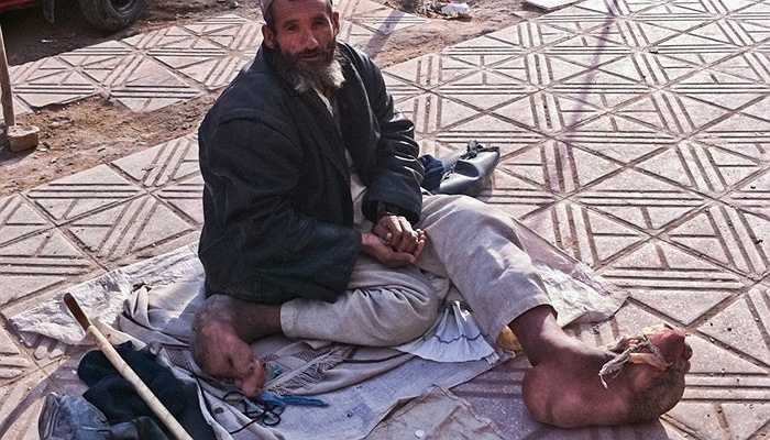 Bệnh phù chân voi - Bệnh chân voi là một bệnh lý do giun chỉ. Về mặt bệnh lý, con giun chỉ sau khi xâm nhập vào người thì nó gây tắt hệ bạch huyết, làm cho bạch huyết không được lưu thông, và tình trạng bị ứ đọng làm cho chân bị phù lên và nó cứng dày lên gọi là phù chân voi.