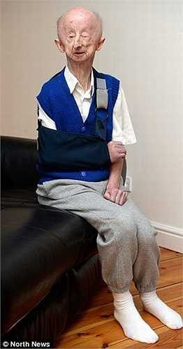 Alan bị tật ở mắt nên chỉ có thể nhìn được một phần. Ông còn gặp vấn đề về khả năng phát triển và thị giác ngay khi sinh ra, do mẹ ông mắc bệnh sởi trong thời gian mang thai.