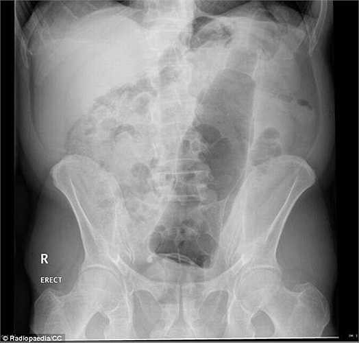 Các nhân viên y tế không thể nhịn cười khi hình ảnh X-quang cho thấy trong hậu môn của bệnh nhân là một chai nước ngọt. 