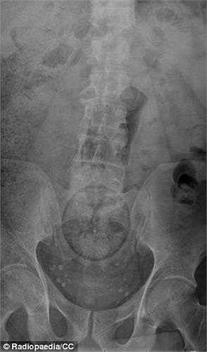 Một trường hợp tương tự là trái cam cũng không may lọt vào trực tràng. 