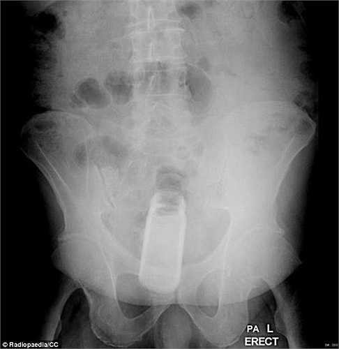 Kỳ lạ hơn, một người đàn ông đã đưa một lọ khử mùi vào hậu môn của mình. 