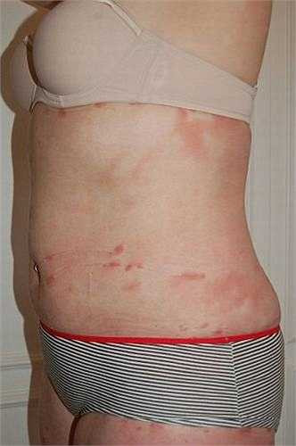 Tuy nhiên, sau khi phục hồi làn da của cô bắt đầu có dấu hiệu bong tróc như bệnh vảy nến. 70% da trên cơ thể Heather bắt đầu phòng rộp sau đó lan lên vùng mặt khiến cả người cô toàn vảy nến màu đỏ.