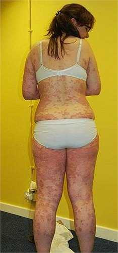 Mỗi đợt bùng phát, da của Heather ngứa ngáy không chịu nổi, trước khi đi ngủ cô đã cố ngăn không gãi nhưng buổi sáng thức dậy, Heather thấy giường cô toàn máu và vảy da. 