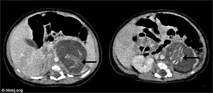 Đây là hiện tượng ‘thai trong thai’ hay còn gọi là song sinh sống ký sinh do thụ tinh bên ngoài phôi - được xem là một trong những trường hợp y học rất hiếm trên thế giới. 