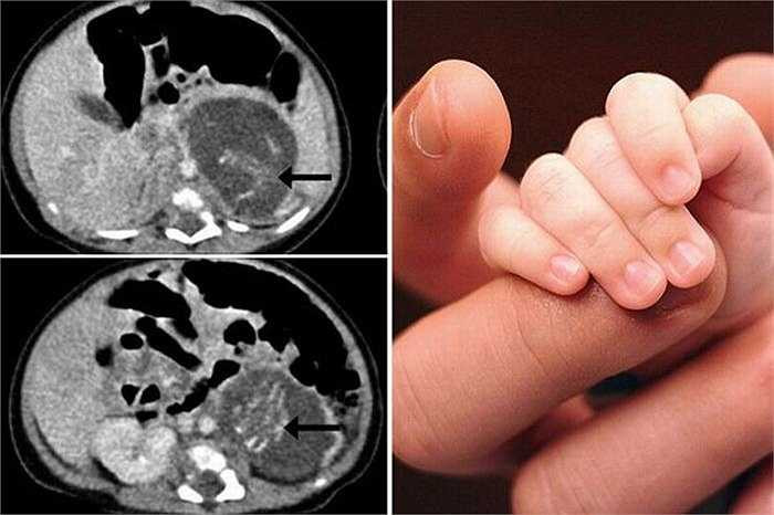 Hiện tại, cô bé đã phục hồi tốt sau cuộc phẫu thuật và được xuất viện 8 ngày sau đó.