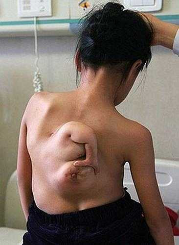 Những kiểm tra và xét nghiệm sâu hơn cho thấy đây là một phần cơ thể của người em song sinh nhưng đã không thể phát triển. 