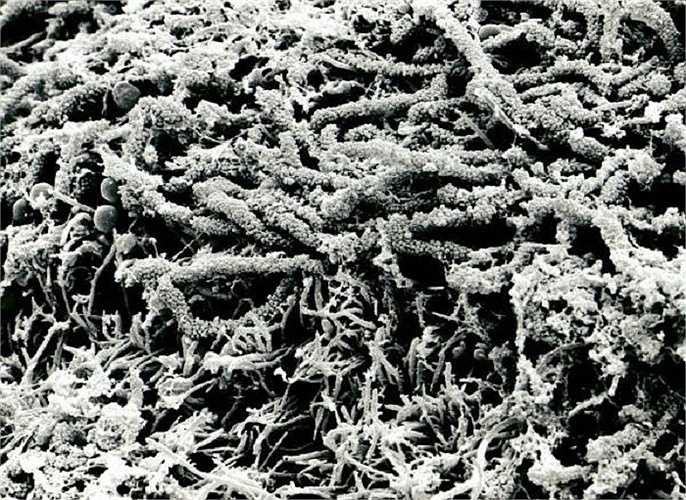 Đây là hình ảnh về những mảng bám trên răng (bựa răng) khi được soi chiếu dưới kính hiển vi.