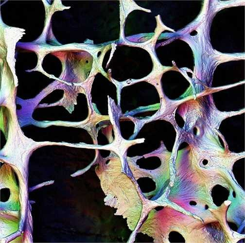 Cấu trúc xương khi bị loãng.