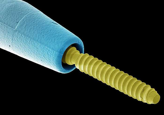 Kim nha khoa được sử dụng để làm chắc phần răng và thân răng khi một phần răng lớn bị sâu hoặc hư.