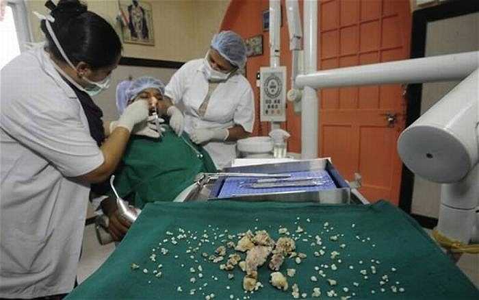 Do mắc phải căn bệnh u răng kết hợp phức tạp nên cậu thanh niên Ashik Gavai, 17 tuổi, người Ấn Độ có tới 232 chiếc răng lớn nhỏ khác nhau mọc chen chúc ở hàm dưới. 
