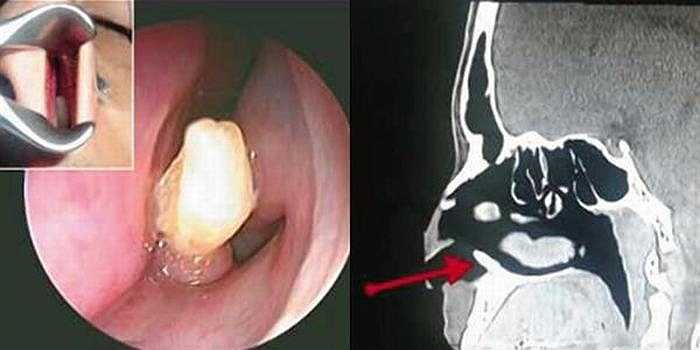 Một nam thanh niên 22 tuổi sống tại Ả-rập Saudi đã được phát hiện mọc răng trong mũi sau khi bị chảy máu mũi không rõ nguyên nhân trong suốt 3 năm.