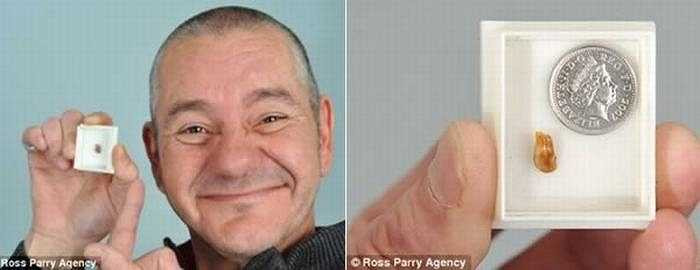 Stephen Hirst (47 tuổi) đã phải chịu đựng những cơn đau đinh tai nhức óc và bị nhiễm trùng bởi 1 chiếc răng bị kẹt sâu trong ống tai suốt hơn 30 năm mà ông không hề hay biết. 