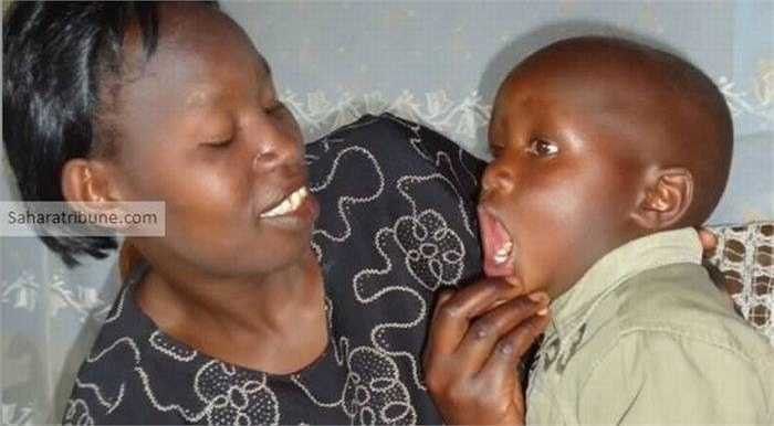 Năm 2010, bé James Mwangi người Kenya chào đời đã có 28 răng. Mặc dù có hàm răng bất thường nhưng bé James vẫn phát triển khỏe mạnh mà không gặp phải vấn đề nào về sức khỏe.