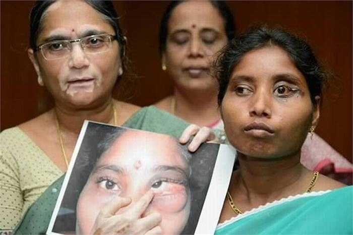 Khuôn mặt chị Siva (người Ấn Độ) trở nên thiếu cân đối kể từ khi khối u bên mắt trái ngày càng phát triển. Sau khi cắt bỏ khối u, các bác sỹ họ phát hiện có 2 chiếc răng hoàn chỉnh mọc lên từ bên trong khối u. 