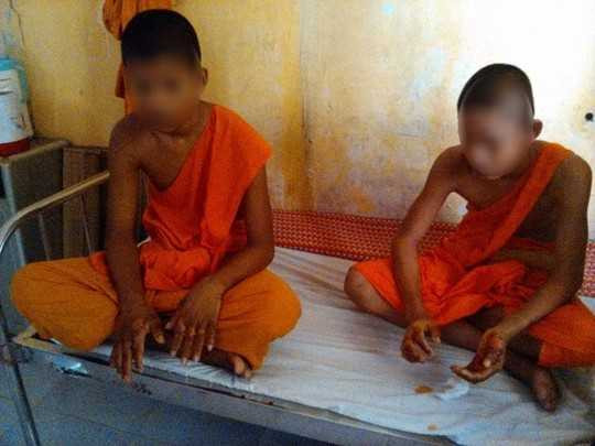 Hai chú tiểu bị ép nhúng tay vào chảo nước sôi