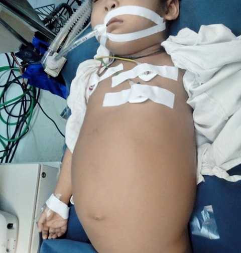 Cắt thành công khối u khổng lồ ở ống mật