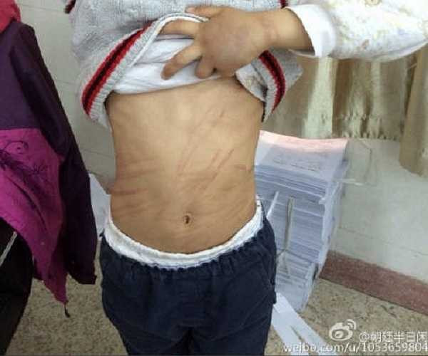 Một bé trai 9 tuổi đã bị mẹ nuôi ngược đãi và hành hạ dã man vì không hoàn thành bài tập về nhà. 