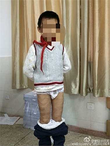 Những bức ảnh cho thấy trên cơ thể cậu bé có rất nhiều vết xẹo, đặc biệt là ở bàn tay, bàn chân và nhất là ở phần lưng.
