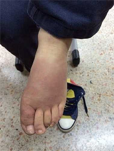 Trước đó, cậu bé từng tâm sự với giáo viên rằng cha mẹ nuôi đã đánh em bằng ống nước, nhánh cây, đốt chân em bằng hơi nước và dùng bút bi đâm vào mặt em.