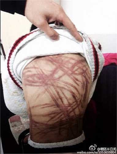 Hiện, người phụ nữ khoảng 50 tuổi, là mẹ nuôi của cậu bé, đã bị cảnh sát bắt giam vì tội cố tình gây chấn thương cho trẻ em và cậu bé tạm thời được trả về cha mẹ đẻ của mình. 