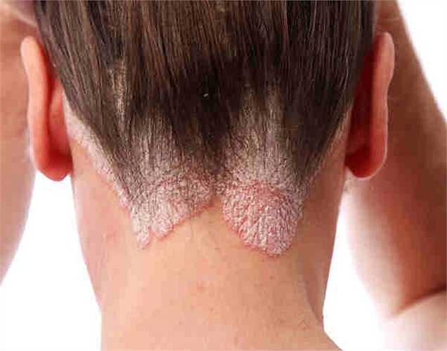 Chống viêm: Tinh dầu hoa hồng giúp ngăn ngừa các vết đỏ và viêm da, nó thậm chí còn được sử dụng để kiểm soát các bệnh về da như bệnh vẩy nến và viêm da dị ứng.