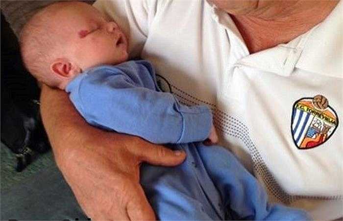Bé Colby Ramos-Francis, 17 tháng tuổi (người Anh) ngay từ khi sinh ra đã có một vết bớt nhỏ màu hồng trên mí mắt.