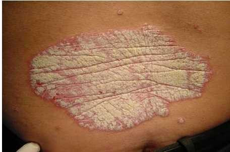 Chuyên gia nói về bệnh vảy nến