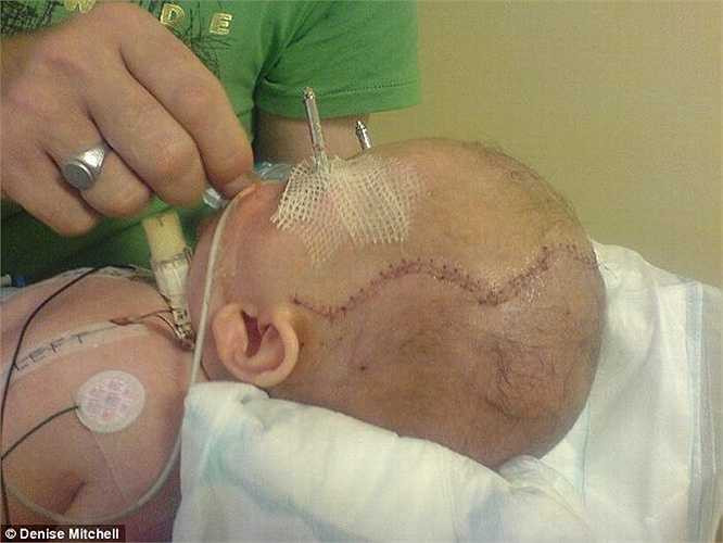 Billy Mitchell (người Anh) sinh ra đã mắc hội chứng Apert - một tình trạng hiếm gặp gây ra dị dạng hộp sọ, mặt, tay và chân.