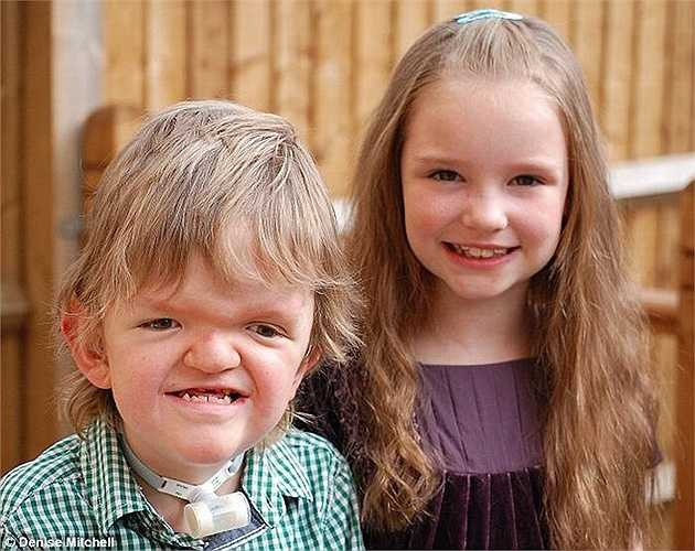 Khi mới được 9 tuần tuổi, Billy đã phải trải qua ca phẫu thuật mở hộp sọ và cấy khung titan vào đầu để định dạng hộp sọ. 