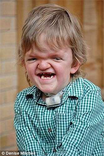 Sau đó, Billy liên tục phải trải qua các cuộc phẫu thuật mắt, chỉnh mũi và tách rời các ngón tay và chân. Bất chấp những khó khăn của mình, Billy đã lớn lên và trở thành một cậu bé điển hình, thích chơi ô tô, đọc sách, và vui đùa cùng chị gái sinh đôi của mình.