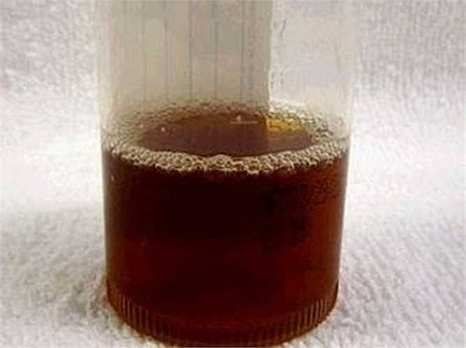 10. Nước tiểu có màu nâu đen hoặc màu trà: Nguyên nhân có thể là do bệnh ở gan, đặc biệt là khi kèm theo các dấu hiệu như màu phân nhợt nhạt, da vàng. Cũng có thể do ảnh hưởng từ loại thuốc đang uống.