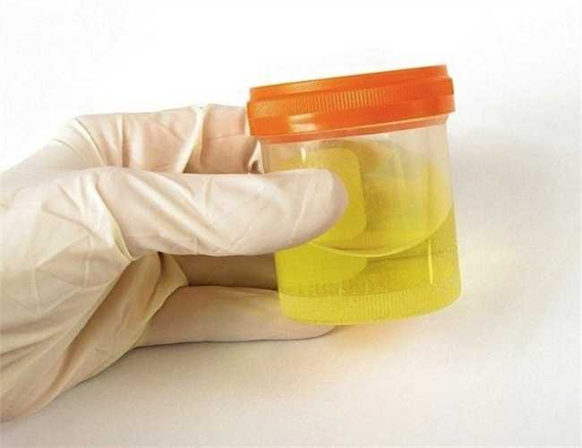 11. Có khí bay ra từ nước tiểu: Có nghĩa vi khuẩn trong thận có thể đã sinh ra khí, được giải phóng khi bạn đi tiểu. Cũng có thể bạn bị rò đường tiểu, lỗ thủng trong thận hay giữa thận và trực tràng. 