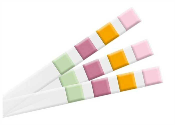 5. Nước tiểu trắng như màu nước gạo: Đây có thể là dấu hiệu của nhiều bệnh, ví dụ viêm niệu đạo do lậu, chlamydia, tiểu dưỡng chấp hay tiểu phosphate.