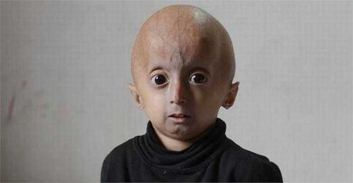 Bé Franco Villavicencio (4 tuổi) sống tại thành phố Moreno (Argentina) sinh ra bình thường nhưng khi gần 1 tuổi cơ thể cậu bé sẽ xuất hiện nhiều dấu hiệu: chậm lớn, rụng tóc và lão hoá da.
