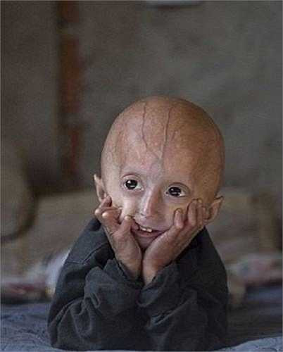 Đây là dấu hiệu của bệnh Progeria (hay còn được gọi là lão hóa sớm) do rối loạn di truyền hiếm gặp khiến cho con người bị già đi nhanh gấp 8 lần bình thường.